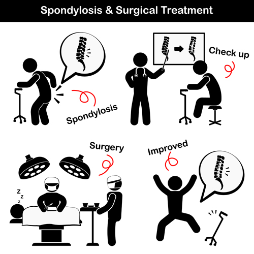 Spondylosis with surgery treatment vector treatment surgery Spondylosis   